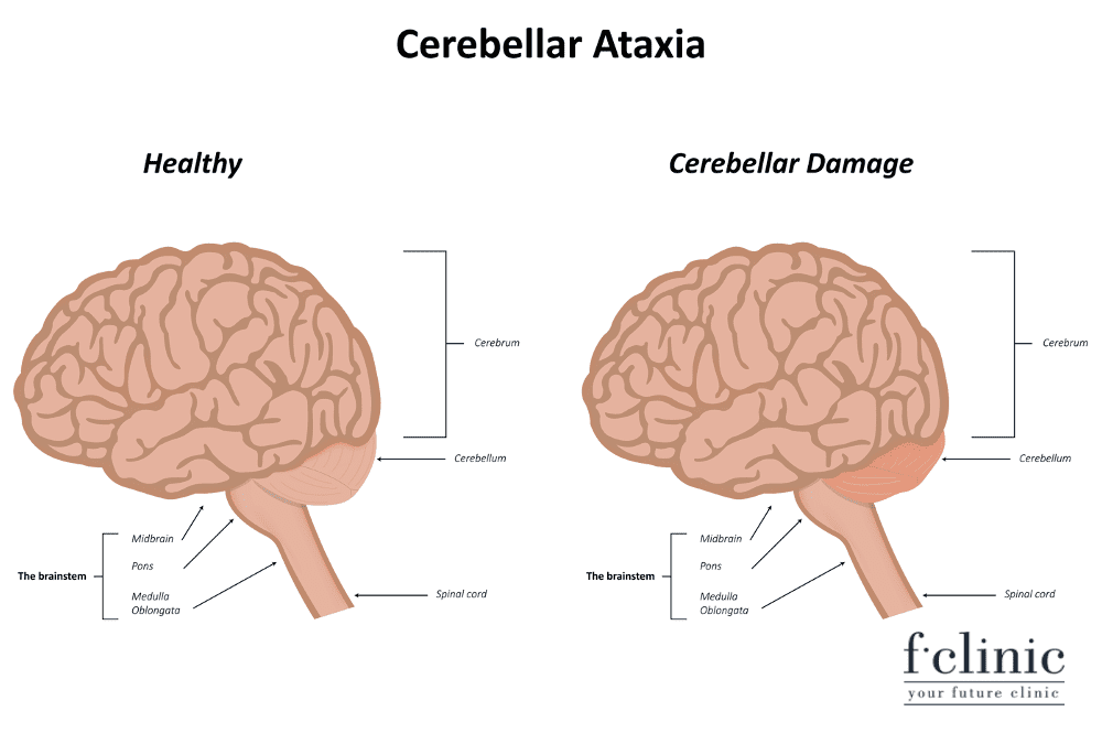 Điều trị bệnh Ataxia